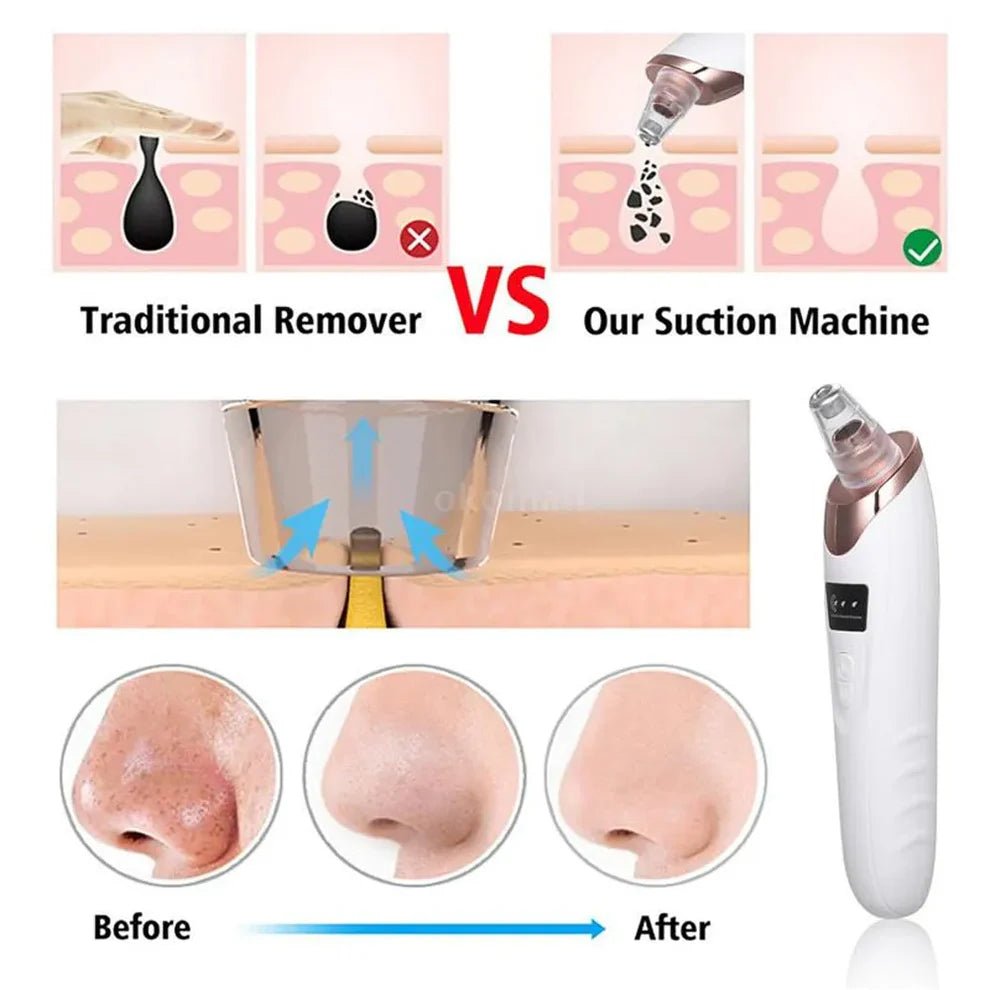 Blackhead Removal Machine – Skin Care & Pore Cleaner - Saadiq.pk