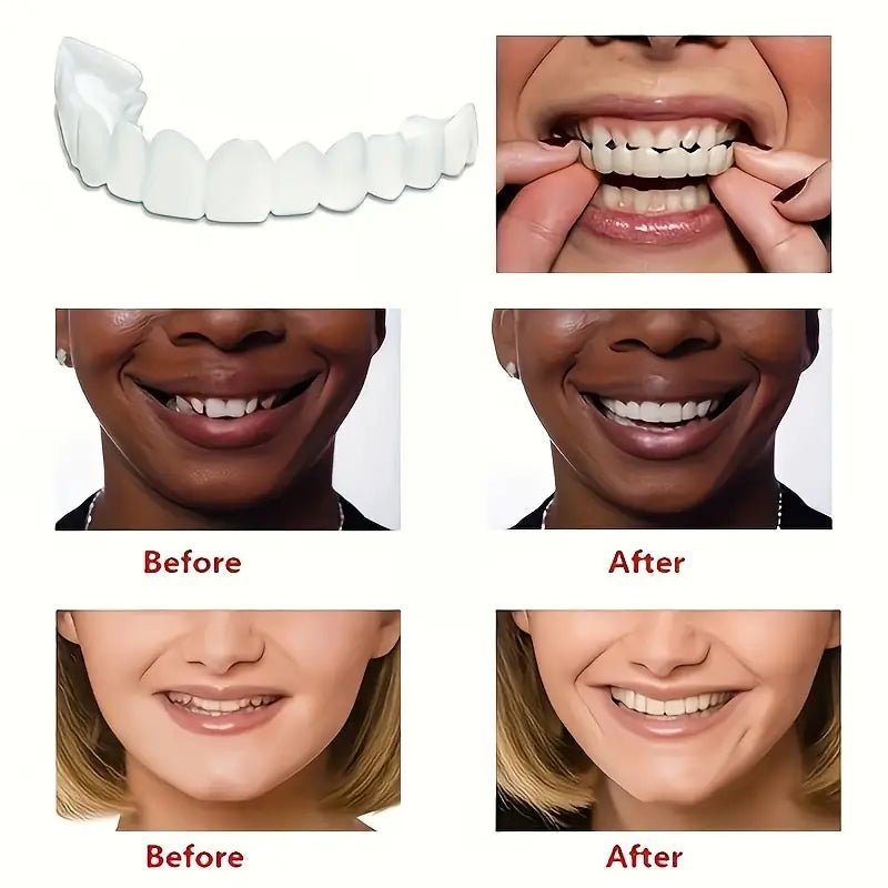 Snap - On Smile Moldable False Teeth Veneers with Artificial Braces Kit for Men & Women – Temporary Cosmetic Dental Solution - Saadiq.pk