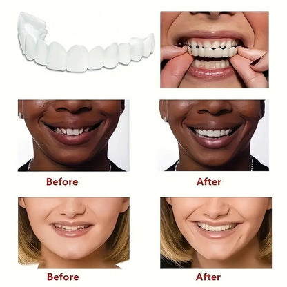 Snap - On Smile Moldable False Teeth Veneers with Artificial Braces Kit for Men & Women – Temporary Cosmetic Dental Solution - Saadiq.pk