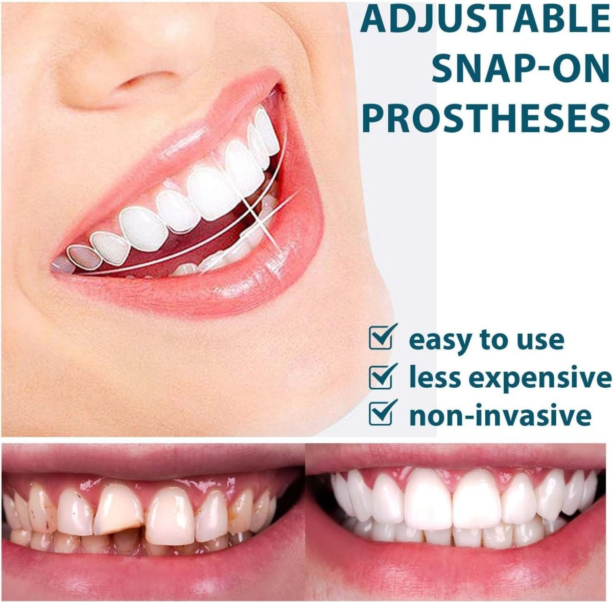 Snap - On Smile Moldable False Teeth Veneers with Artificial Braces Kit for Men & Women – Temporary Cosmetic Dental Solution - Saadiq.pk